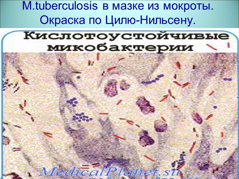 M.tuberculosis в мазке из мокроты. Окраска по Цилю-Нильсену.